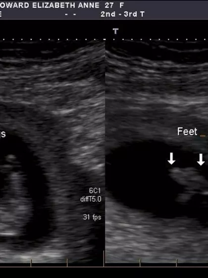 Liz – Surrogate Mother in Johnsonville, New Zealand
